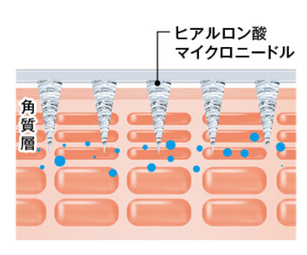 刺すヒアルロン酸「ヒアロディープパッチ」の仕組み