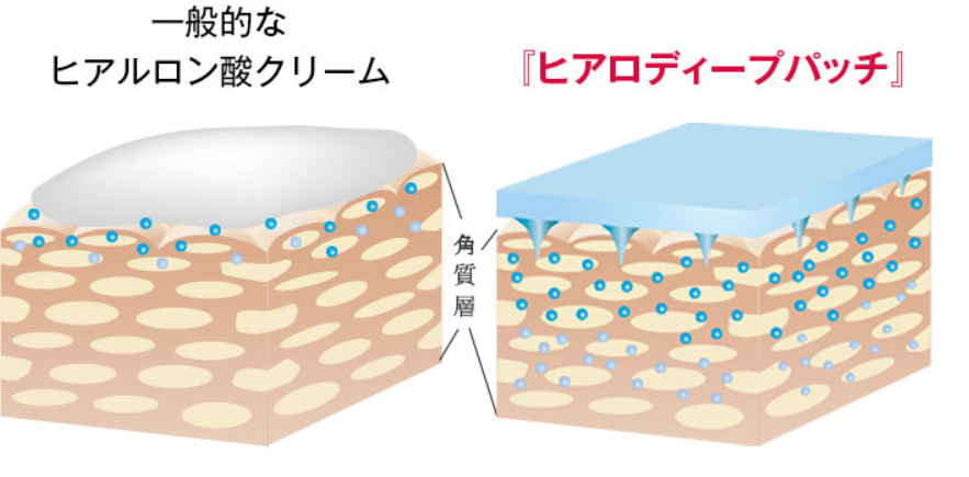 刺すヒアルロン酸「ヒアロディープパッチ」他社との比較